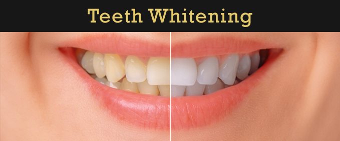 Teeth Whitening in Rock Hill, SC