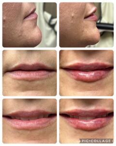 Lip Augmentation in Rock Hill at Espinal & Willis