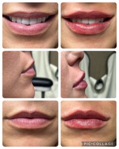 Lip Augmentation in Rock Hill at Espinal & Willis