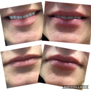 Lip Augmentation in Rock Hill at Espinal & Willis