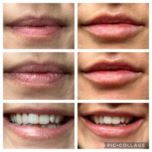 Lip Augmentation in Rock Hill at Espinal & Willis