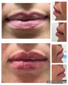 Lip Augmentation in Rock Hill at Espinal & Willis